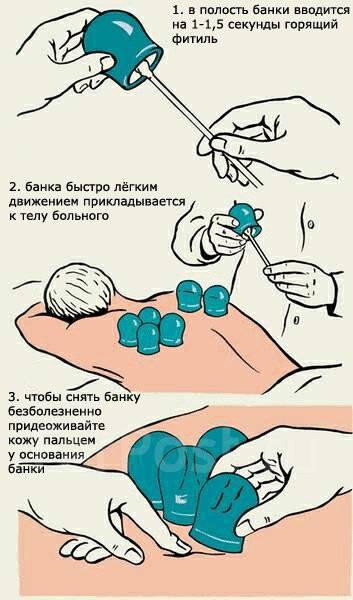 Схема установки вакуумных банок