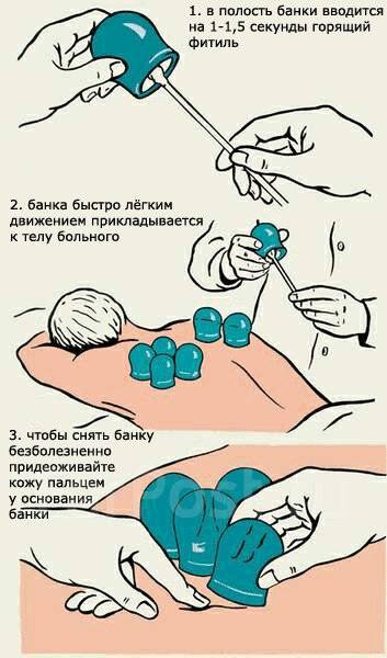 Как установить банки. Место постановки банок на спину при кашле. Схема постановки медицинских банок. Как ставить медицинские банки на спину. Постановка банок на спину алгоритм.