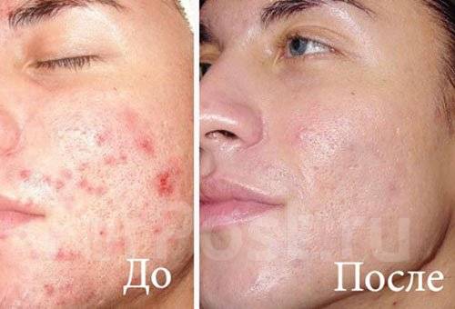 Лазерное омоложение Заовражная улица Чебоксары