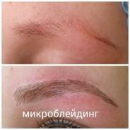 Удаление татуировок.