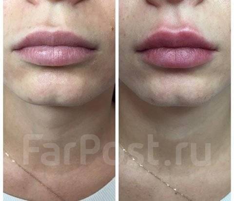 Диспорт губы до и после Диспорт, увеличение губ, мезотерапия, биоревитализация во Владивостоке