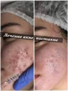 Чистка лица . Лечение акне