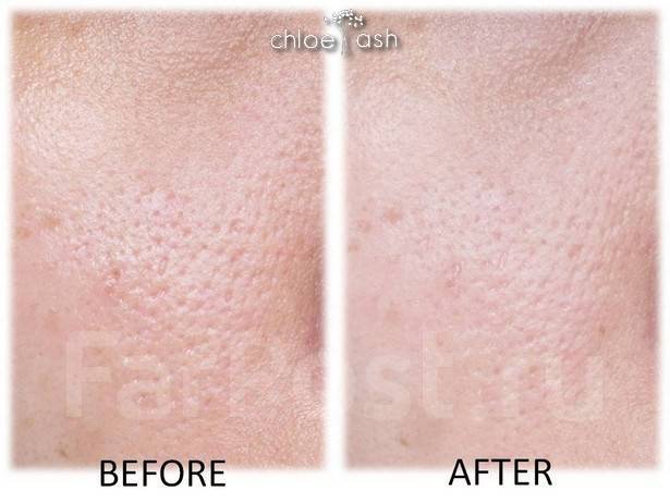 Крем скрывающий поры. Расширенные поры и рубцы. Тоналка которые не засоряет поры. Забитые поры на лице от тонального крема. Крем скрывающий поры.