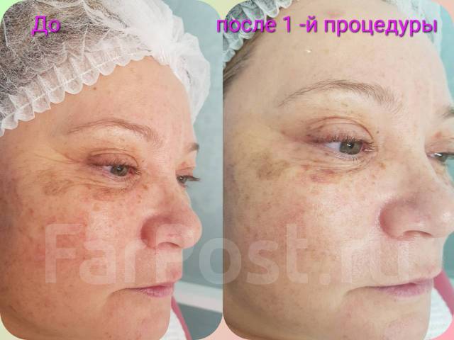 Ультразвуковая чистка лица, маска Альгинат. BB GLOW Treatment, пилинги