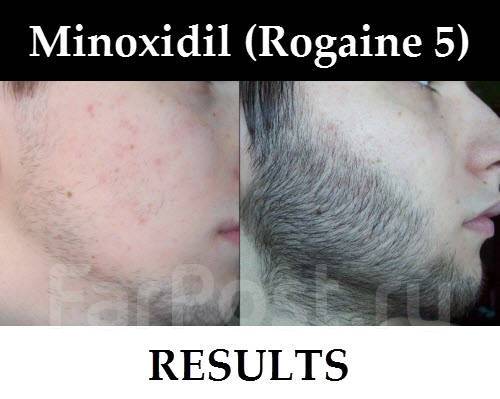 Как правильно наносить миноксидил киркланд для бороды - 86 фото