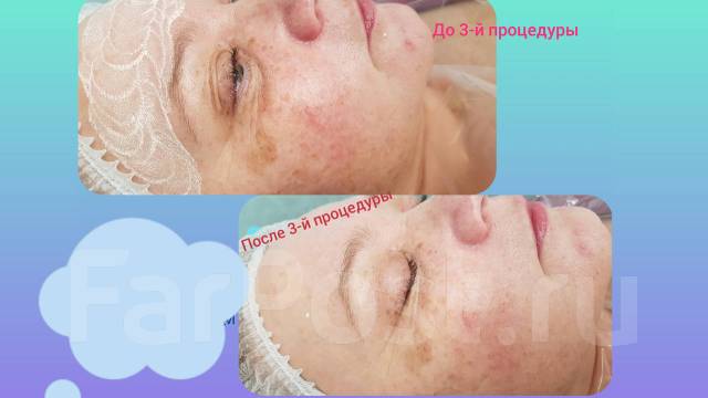 Ультразвуковая чистка лица, маска Альгинат. BB GLOW Treatment, пилинги