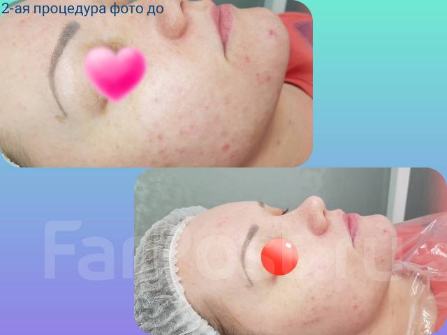 Ультразвуковая чистка лица, маска Альгинат. BB GLOW Treatment, пилинги