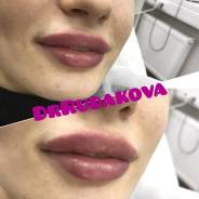 Увеличение губ