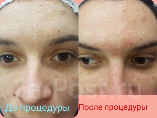 Ультразвуковая чистка лица, маска Альгинат. BB GLOW Treatment, пилинги