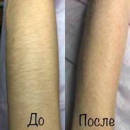 Электроэпиляция