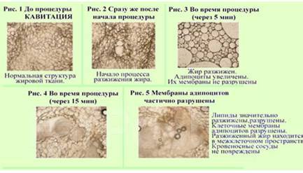 Элос эпиляция картинки