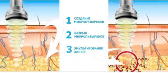 Кавитация лица до и после Кавитация на Луговой во Владивостоке