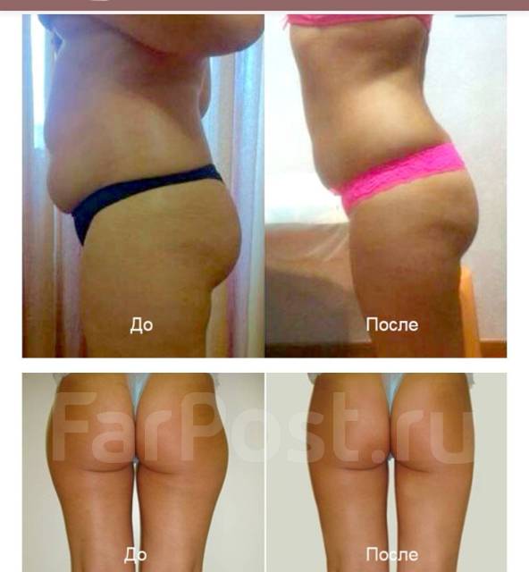 Антицеллюлитный ролико-вакуумный массаж в Уссурийске