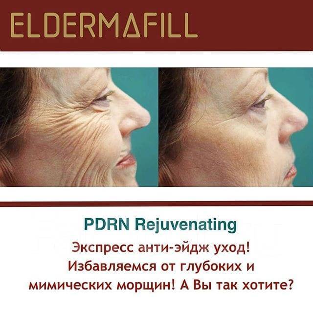 Пдрн фото до и после отзывы