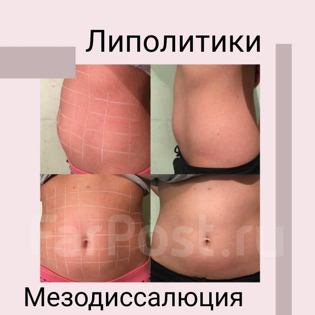 Липолитики в живот противопоказания и побочные эффекты. Акваликс липолитик до и после фото. Непрямой липолитик в живот. Подтяжка живота липолитики. Мезотерапия живота для похудения.