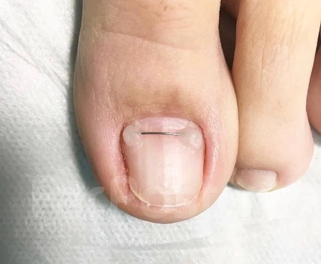 Установка Титановой нити- решение проблемы вросшего ногтя. Выезд на дом ...