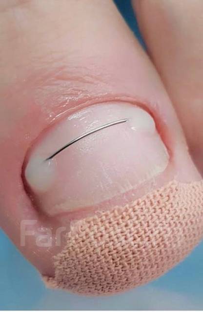 Установка Титановой нити- решение проблемы вросшего ногтя. Выезд на дом ...
