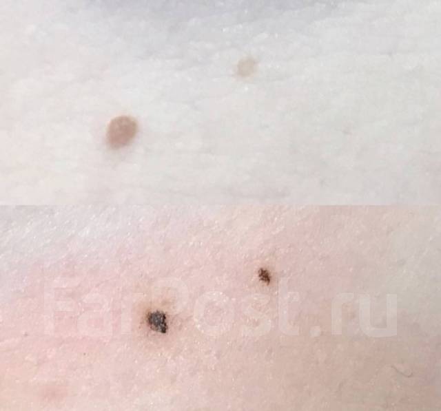 Удаление папиллом на лице, теле и в интимных местах! Возможен выезд во ...