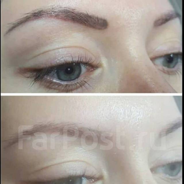 Удаление перманента /татуажа от 2000р во Владивостоке