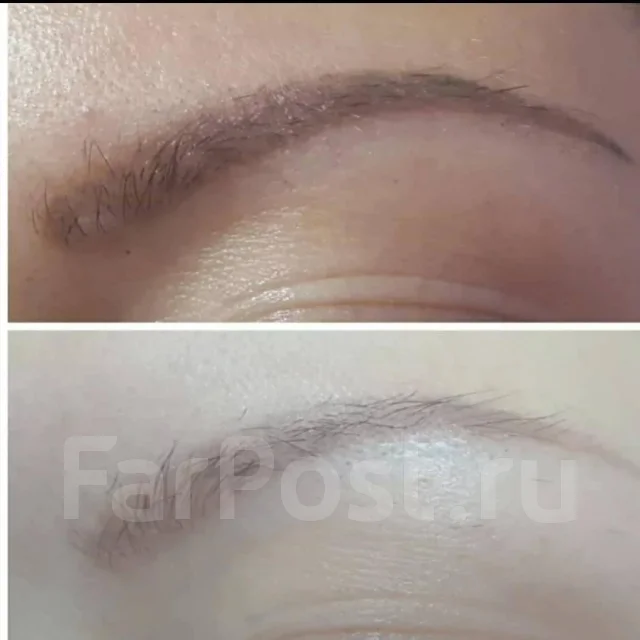 Удаление перманента /татуажа от 2000р во Владивостоке