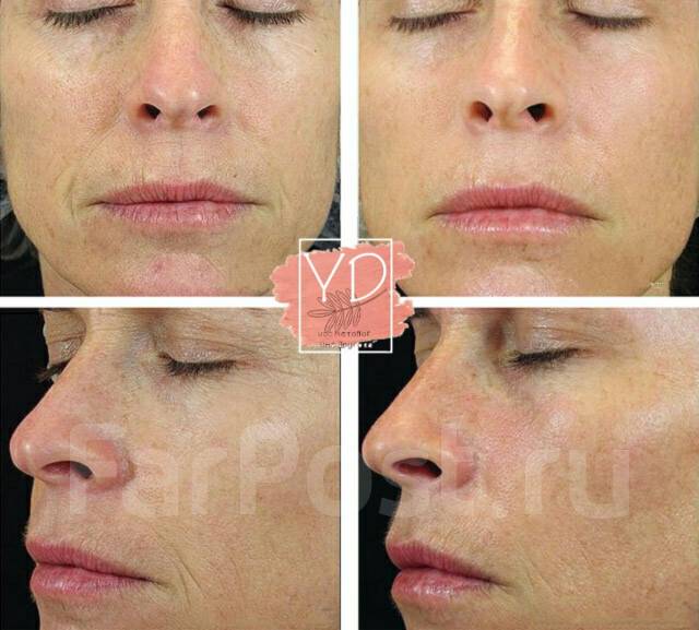 Lpg лица до и после. Lpg лица до и после. Буккальный массаж до и после. Lpg лица до и после. Лицо до и после массажа лица.