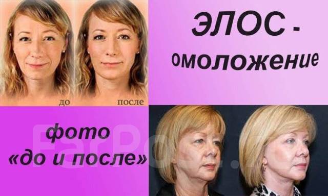 Элос омоложение лица фото до и после