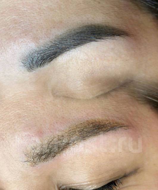 Удаление татуажа, татуировок во Владивостоке