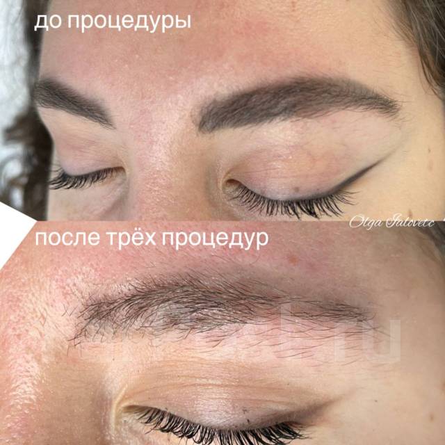 Удаление Татуажа, Лазер, Ремувер, р-он Столетие во Владивостоке