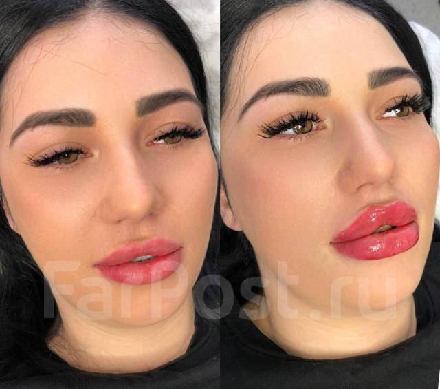 Косметолог Снеговая падь. Косметолог ДСК. Ботокс. Чистка лица ...