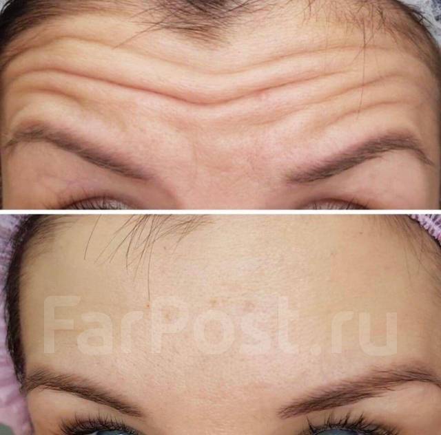 Косметолог Снеговая падь. Косметолог ДСК. Ботокс. Чистка лица ...