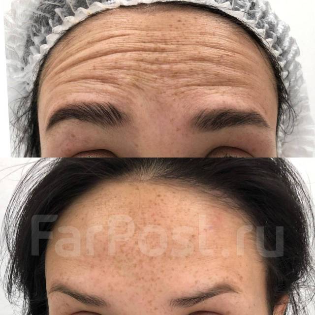 Косметолог Снеговая падь. Косметолог ДСК. Ботокс. Чистка лица ...