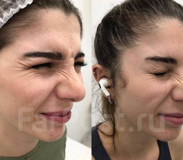 Косметолог Снеговая падь. Косметолог ДСК. Ботокс. Чистка лица ...