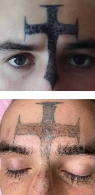 Лазерное удаление тату и татуажа - Косметология и красота во Владивостоке