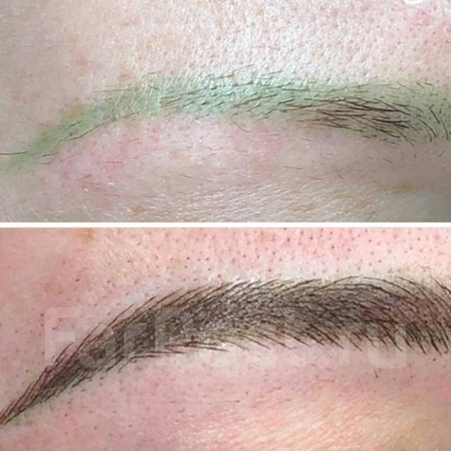 Удаление татуажа, татуировки во Владивостоке