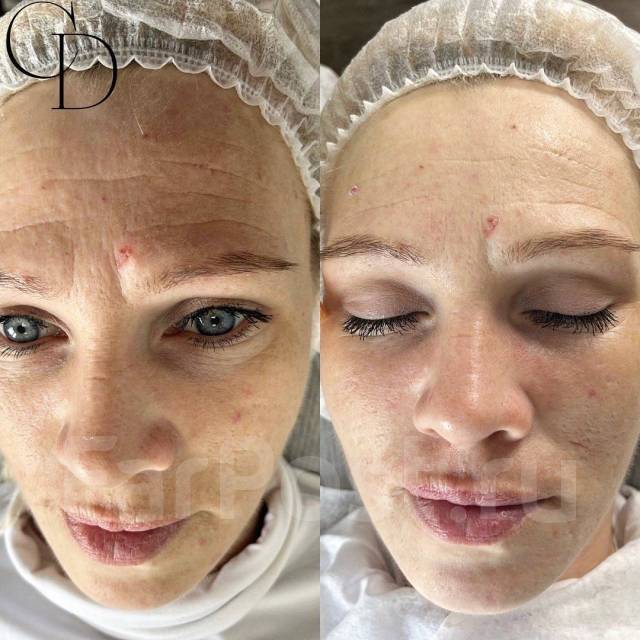 Лазерное омоложение кожи! Фотоомоложение! Акне! Элос эпиляция во ...