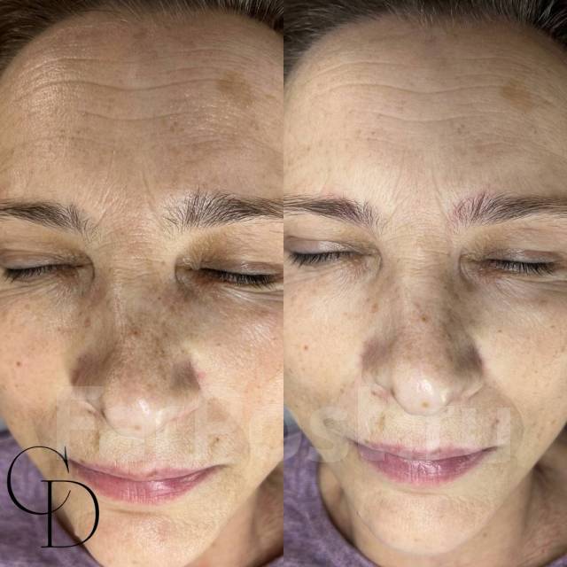 Лазерное омоложение кожи! Фотоомоложение! Акне! Элос эпиляция во ...