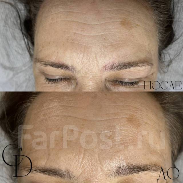 Лазерное омоложение кожи! Фотоомоложение! Акне! Элос эпиляция во ...