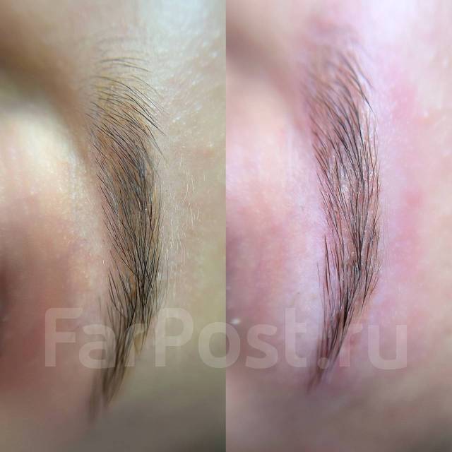 Удаление перманентного макияжа, тату, лазером и ремувером в Артеме