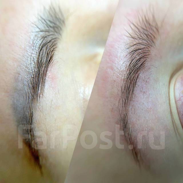 Удаление перманентного макияжа, тату, лазером и ремувером в Артеме