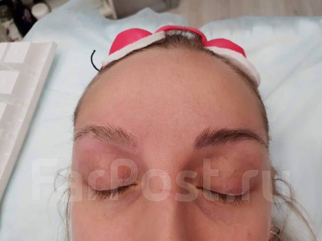 Удаление татуажа и тату (-30%) - Косметология и красота в Артеме