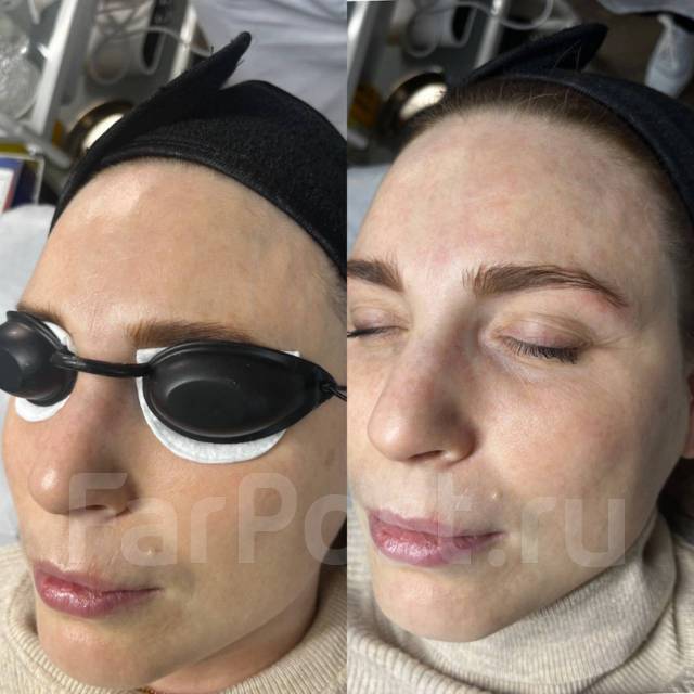 Лазерное омоложение кожи! Фотоомоложение! Акне! Элос эпиляция во ...