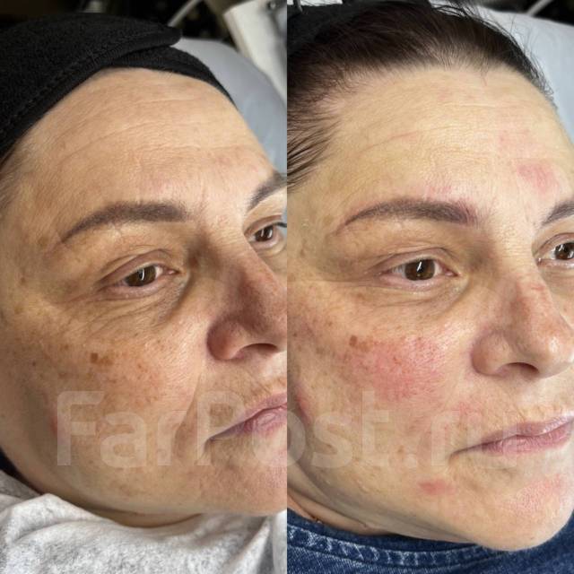 Лазерное омоложение кожи! Фотоомоложение! Акне! Элос эпиляция во ...