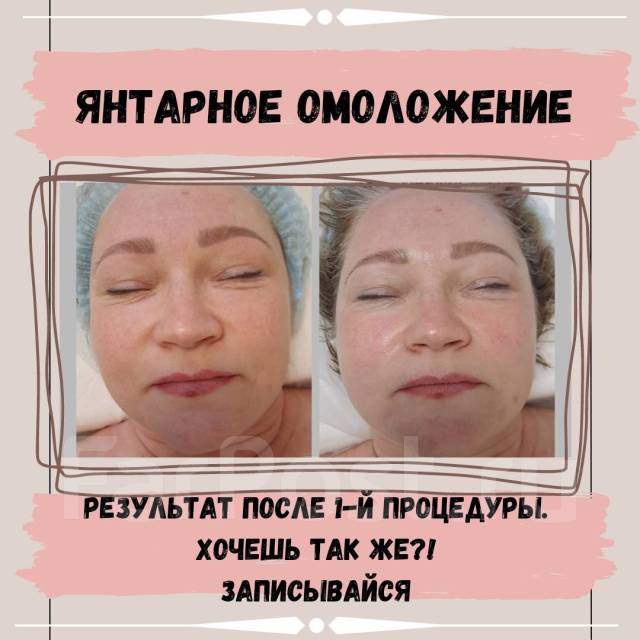 янтарное омоложение