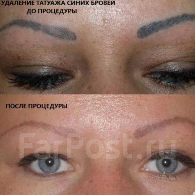 Удаление тату PicoSure