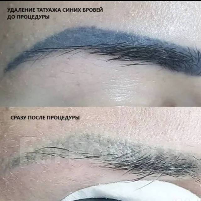 Удаление тату и перманентного макияжа лазером - Косметология и красота ...