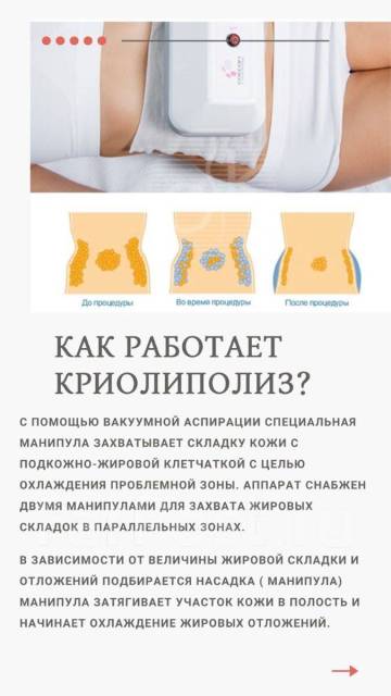 Криолиполиз в новосибирске цена отзывы фото