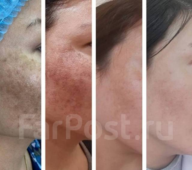 Фотоомоложение до и после реальные фото М22 до и после