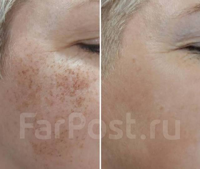 Фотоомоложение лица. Лазерное омоложение лица. Гарантия во Владивостоке