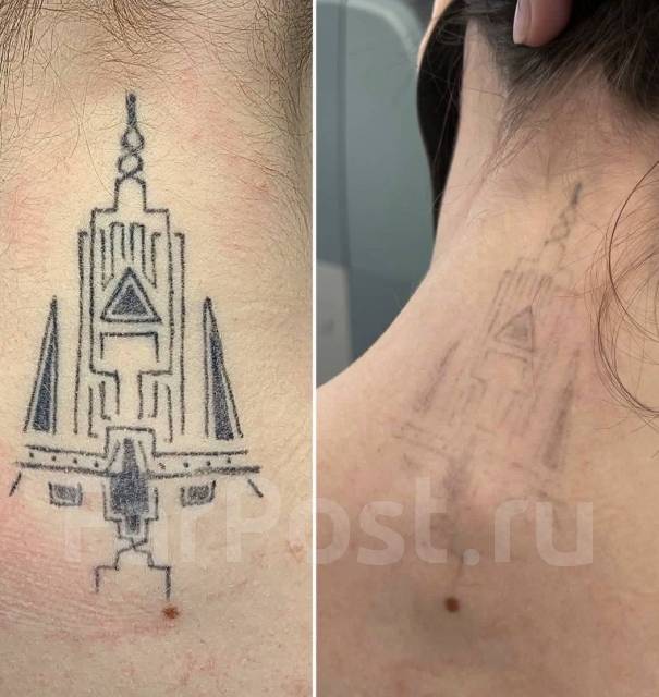 Удаление татуировок, удаление татуажа бровей, губ в Уссурийске