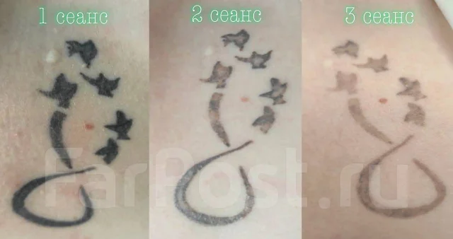 Удаление тату лазером, сведение татуировок, выведение перманента во ...